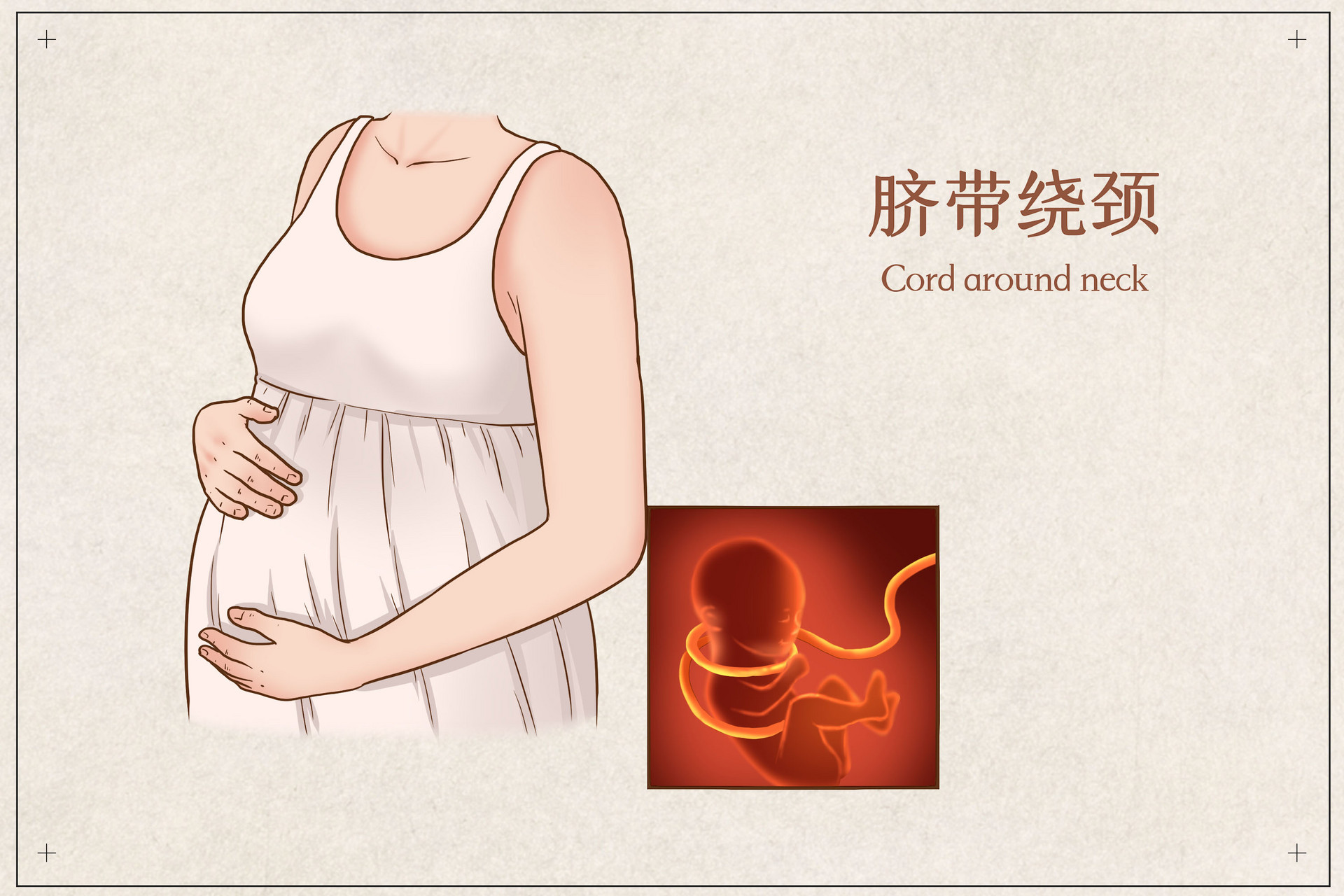 孕期胎儿脐带绕颈一般是由于什么原因导致的？ - 知乎